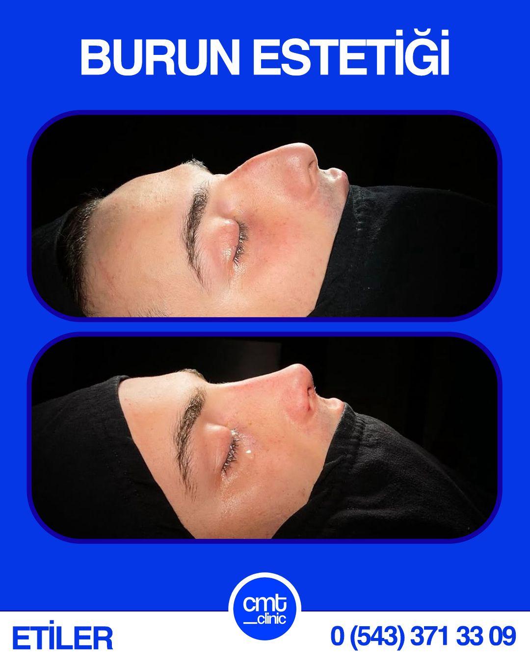 Mükemmel Rhinoplasty