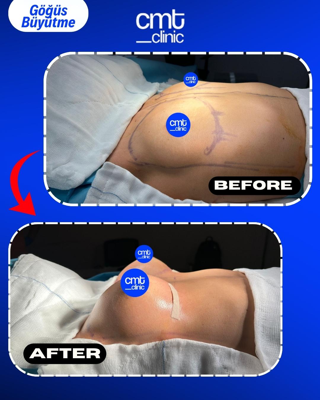 Göğüs Büyütme
