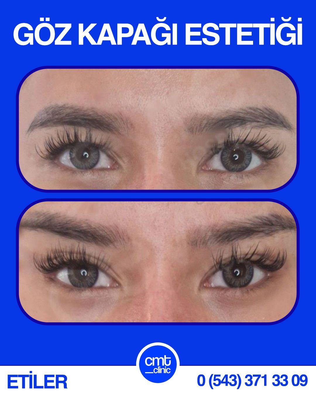 Göz Kapağı Estetiği